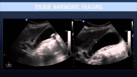 Ultrasounds Made Easy Part III: Tissue Harmonic Imaging