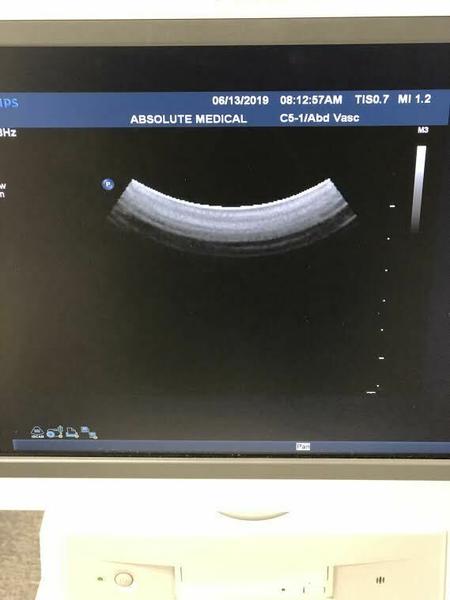 Philips C5-1 Curved Array Probe