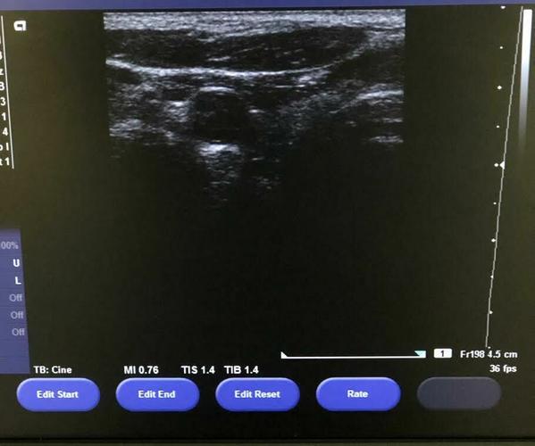 Siemens Acuson VF10-5 Linear Array Probe