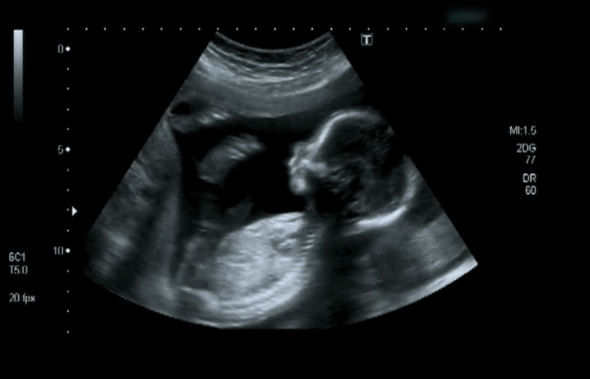 Understanding Abdominal Ultrasounds