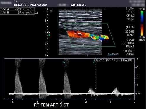 How It Works: Vascular Ultrasound Probes and Transducers