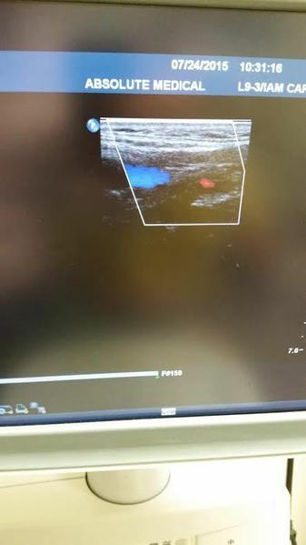 Philips IU22 Ultrasound Machine