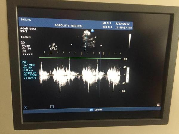 Philips HD 15 Ultrasound System