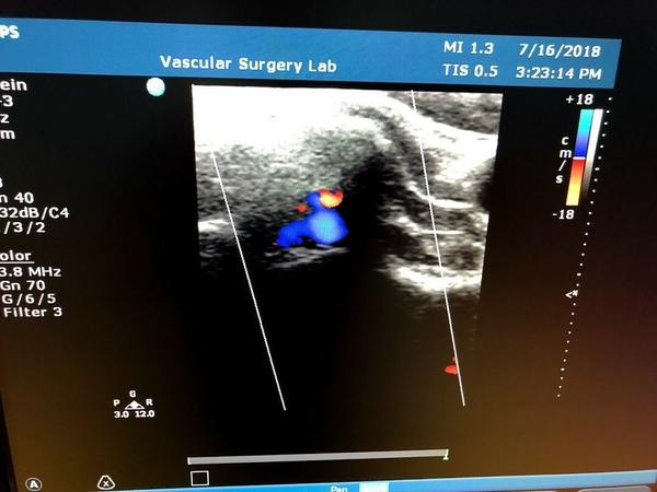 Philips L12-3 Linear Array Probe