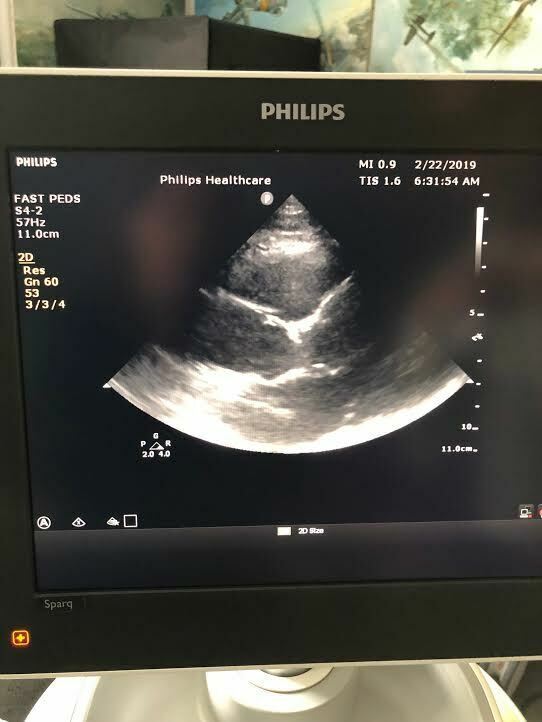 Philips S4-2 Sector Array Phased Array Cardiac Probe Transducer for Sparq