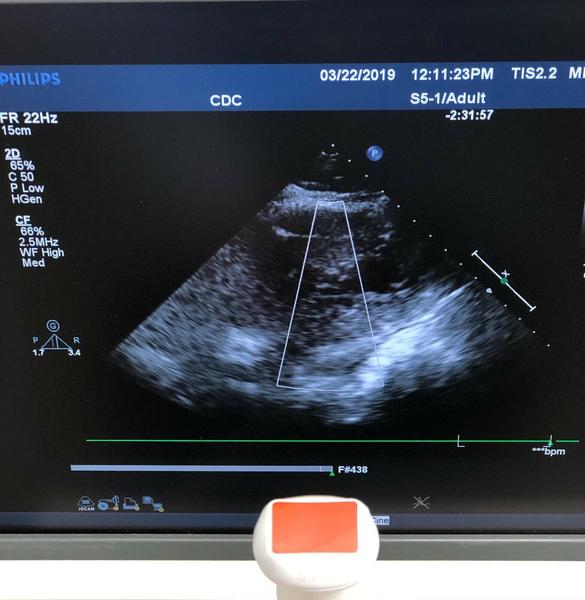 Philips S5-1 Sector Array Probe