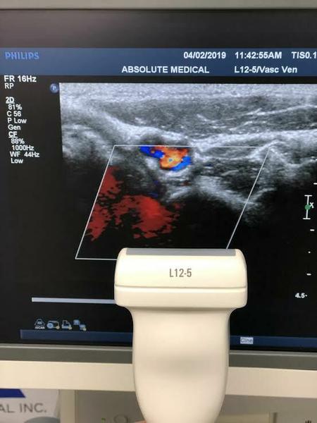 Philips L12-5 Linear Array Probe